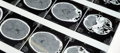 Brain scan images showing neurological activity for TMS therapy.